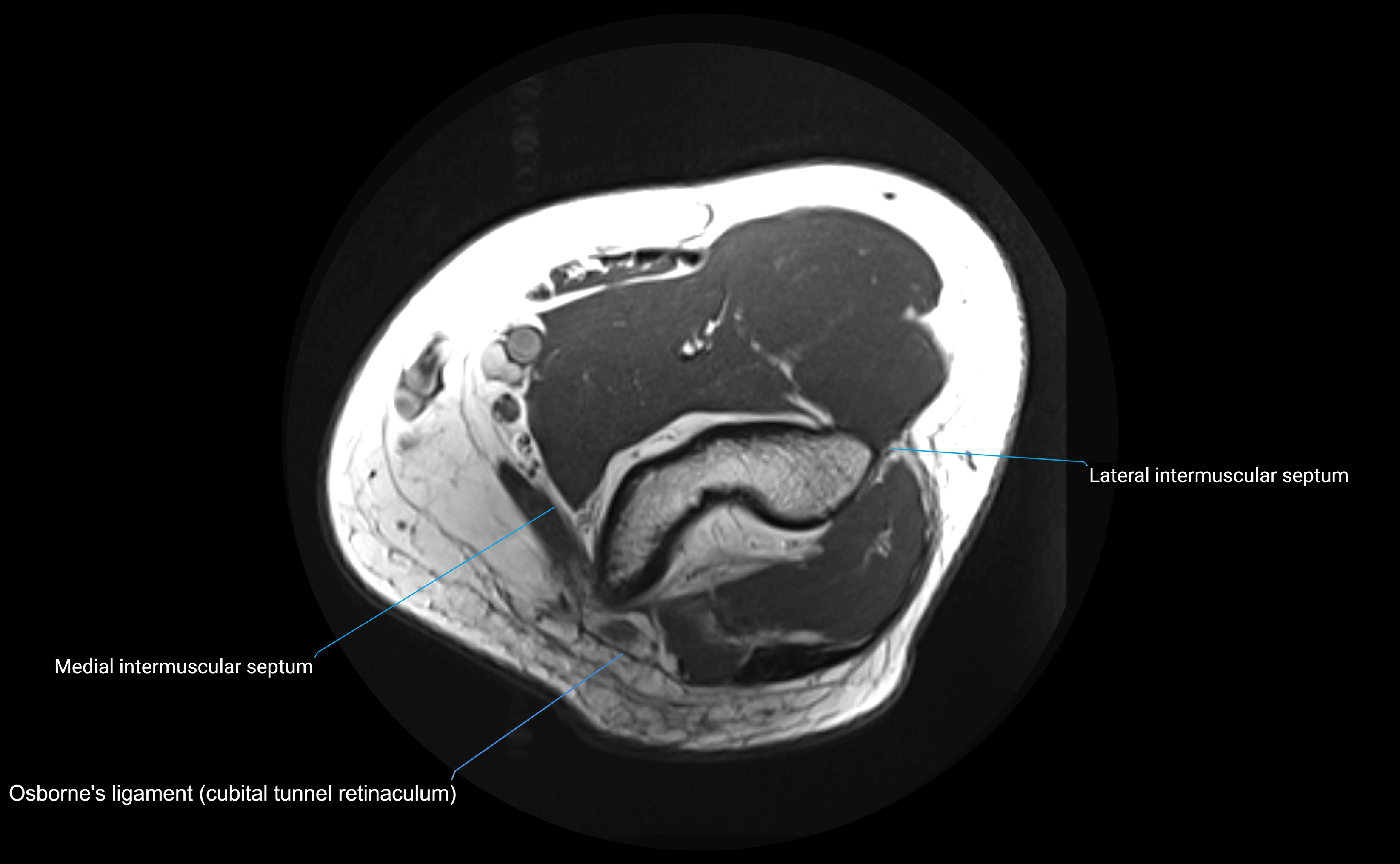 MRI elbow ligaments axial cross sectional anatomy 3T  radiology  image-img-00001-00008.webp